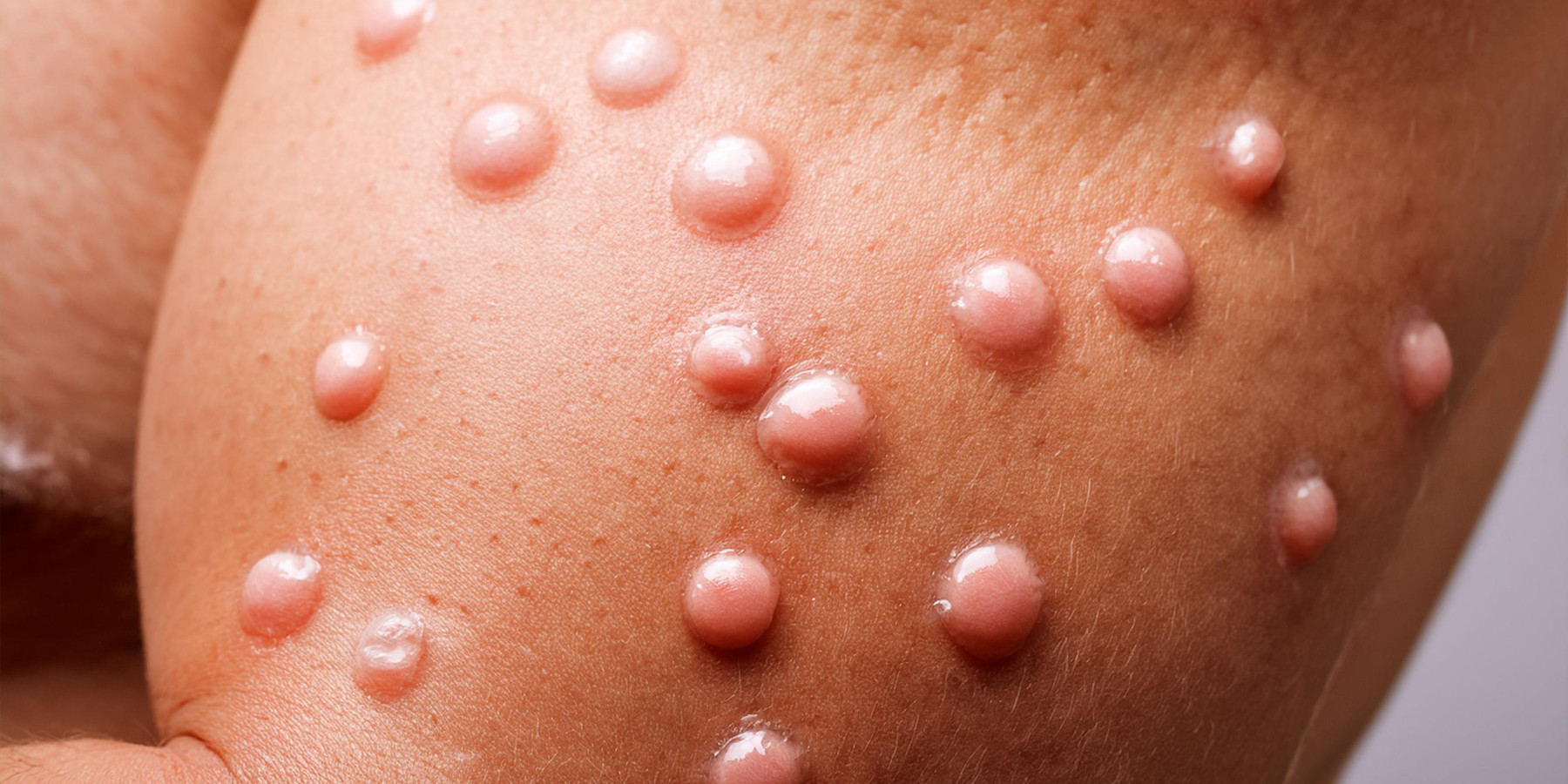 Molluscum contagiosum